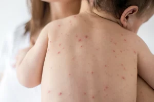 ALERTA: Risco de epidemia nacional de sarampo preocupa Vitória da Conquista – Vacine as crianças