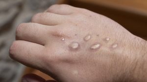 Vitória da Conquista tem 02 casos suspeitos de Monkeypox, conhecida como varíola do macaco