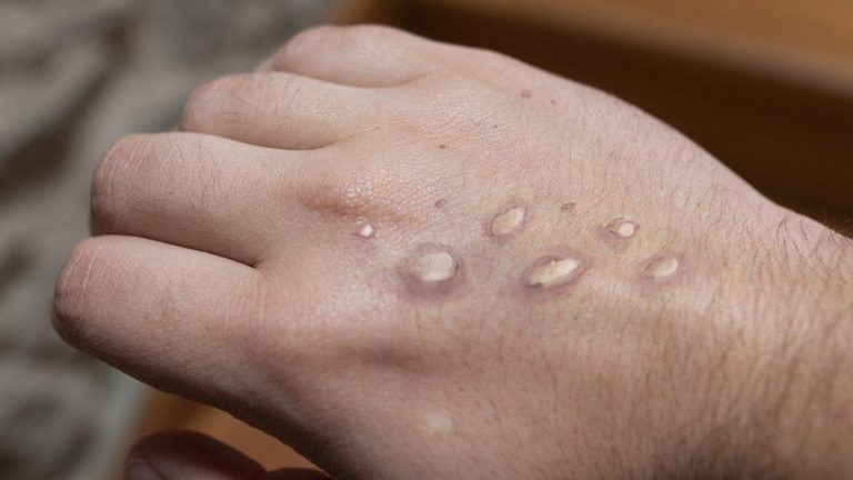Vitória da Conquista tem 02 casos suspeitos de Monkeypox, conhecida como varíola do macaco