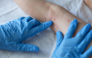 Novo caso de Monkeypox é confirmado na Bahia