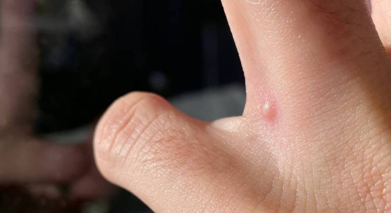 Especialista em pele fala sobre preconceito e a verdade sobre a varíola dos macacos