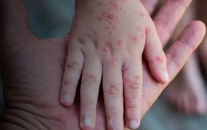 Segundo caso de Monkeypox confirmado em Conquista e mais 02 em investigação
