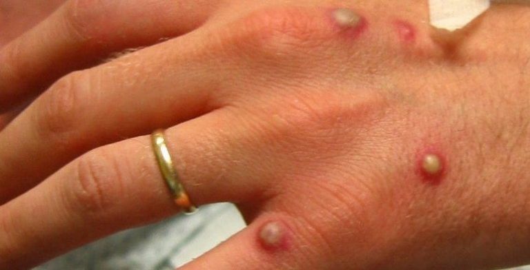 URGENTE: Terceiro caso de Monkeypox (varíola dos macacos) é confirmado pela SMS em Vitória da Conquista