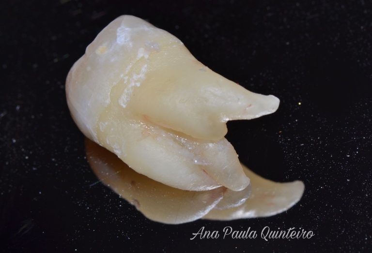 Qual a idade ideal para retirar o siso? É recomendado fazer a cirurgia em todos os casos? Especialista tira dúvidas