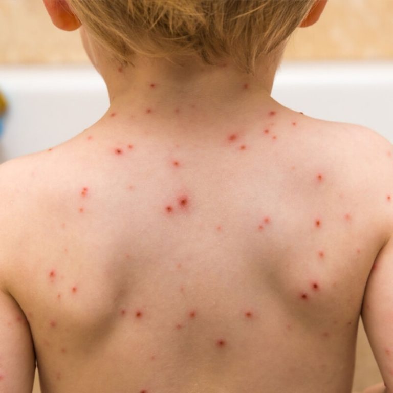 Baixa cobertura vacinal da Varicela é a causa do surto de catapora na Bahia. Em Vitória da Conquista falta vacina