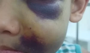 Vitória da Conquista: Mãe de menino internado com hematomas cobra escola: ‘Entreguei bom’