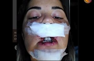 [Imagens Fortes]: Mulher perde parte da boca e do queixo após fazer um preenchimento labial