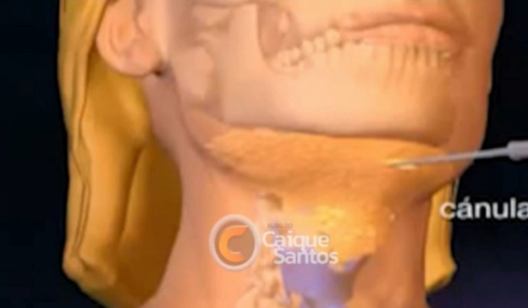 Defesa de biomédica fala sobre complicações de saúde após procedimento estético em Vitória da Conquista