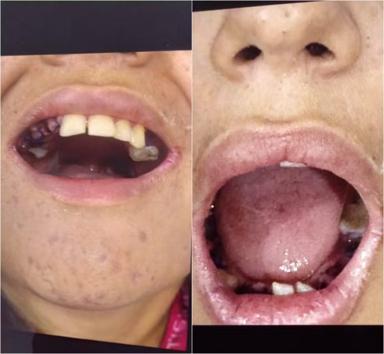 Jovem autista de 19 anos tem 17 dentes arrancados em Belém durante atendimento odontológico; família denuncia erro médico