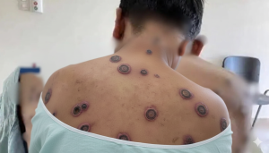 Secretaria de Saúde de Vitória da Conquista divulga novas informações sobre vírus Mpox